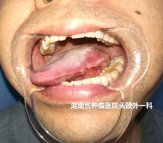 舌癌的中期症状图片图片