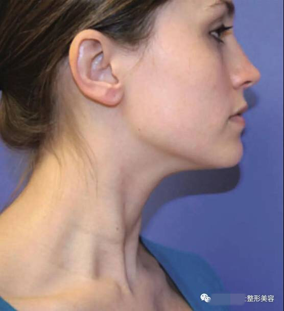 年轻漂亮的脖子有着明确的特征:肤质良好,颏颈角明显,角度在105°至