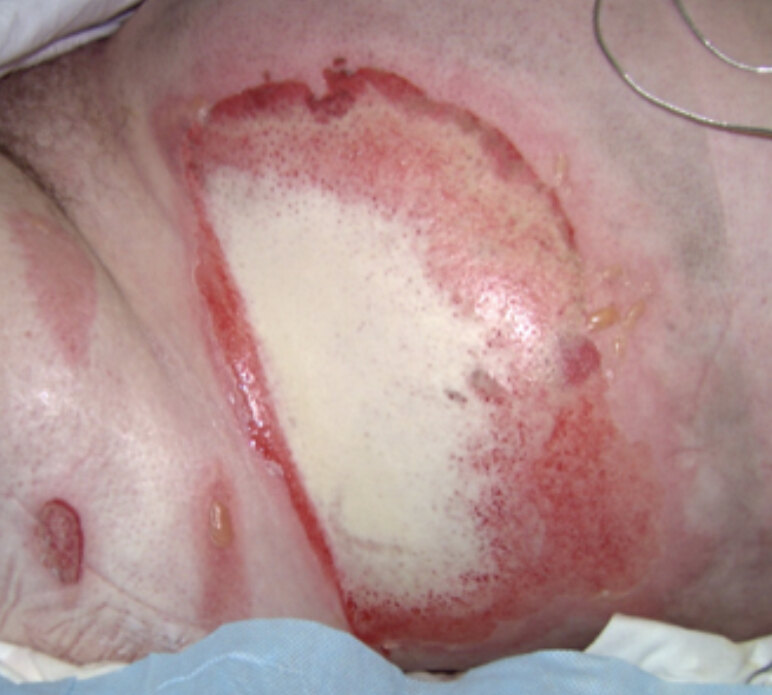 高锰酸钾灼伤皮肤图片图片