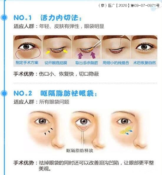 单纯去眼袋or眶隔脂肪释放填充泪沟?应该如何选择!