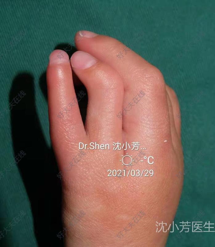 多指_先天性并指多指畸形 - 好大夫在线