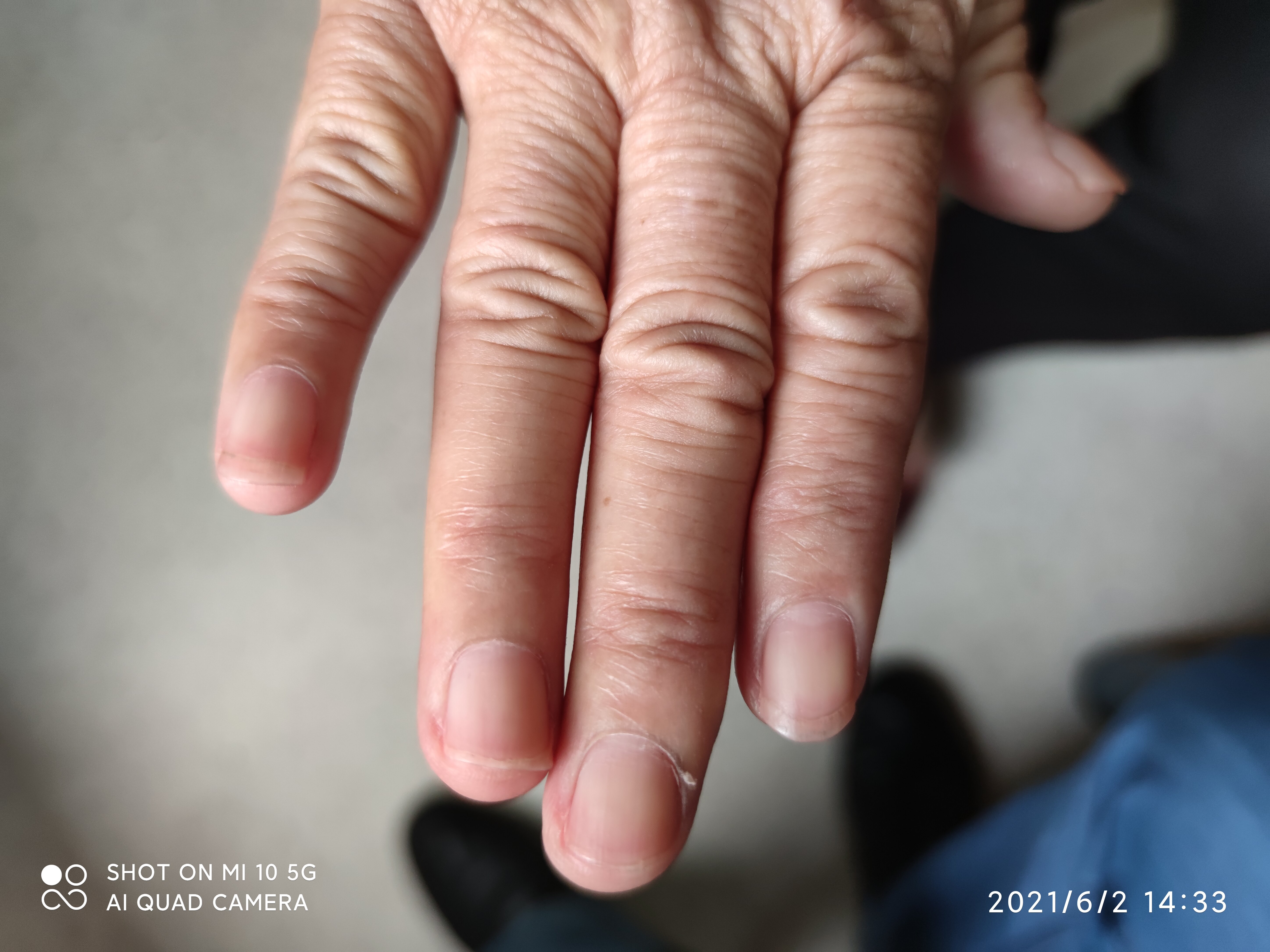 科普:手足综合征_手足口病_手足口病介绍 - 好大夫在线