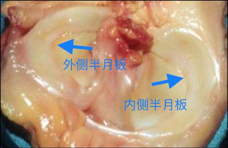 半月板后角变性严重么图片