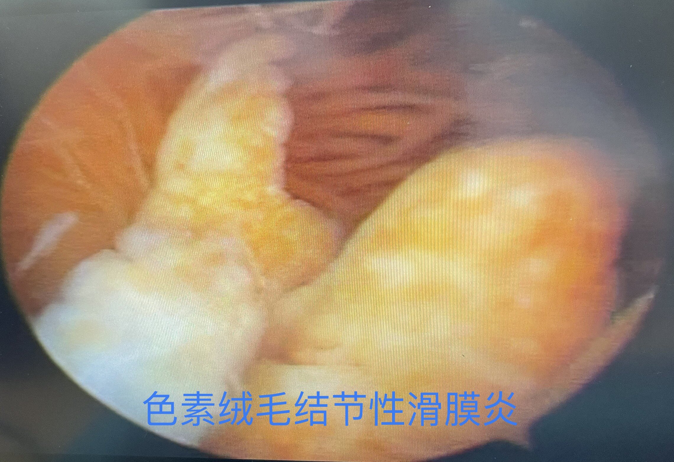 膝关节镜下见滑膜组织增生行关节腔穿刺抽液看见绒毛结节性滑膜炎积液