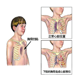 漏斗胸小科普一