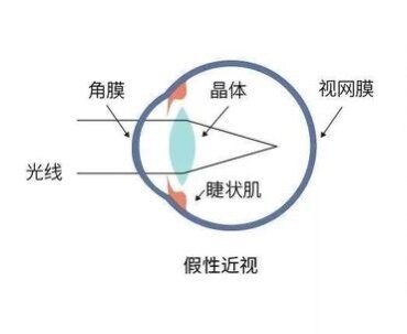 假性近視是由於用眼過度致使睫狀肌持續收縮痙攣,晶狀體變凸,物象成像