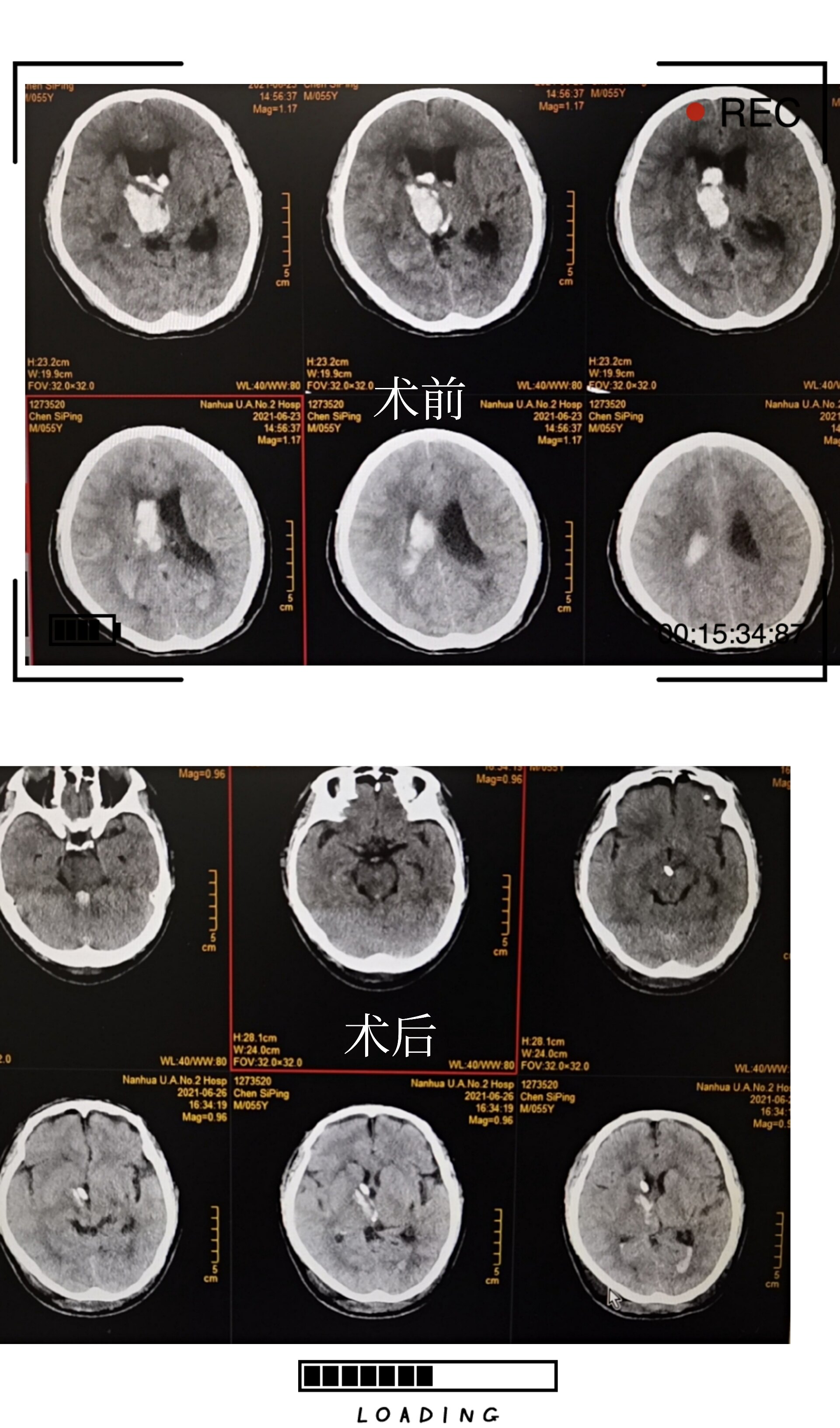 丘脑出血预后图片