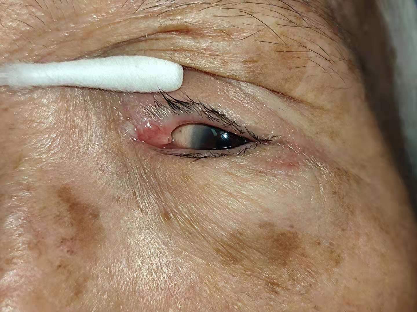 顽固的结膜炎——甄士隐的故事_结膜炎_介绍_治疗方式_日常注意事项