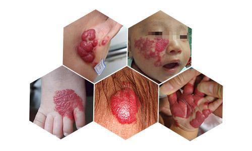 皮肤血管瘤的类型和治疗概况_皮肤血管瘤_介绍_治疗方式 - 好大夫在线