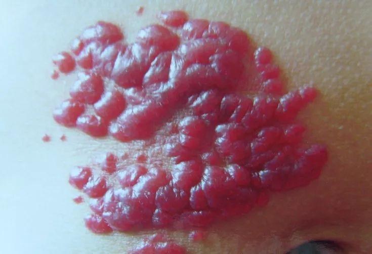 皮肤上长红色血管瘤图片