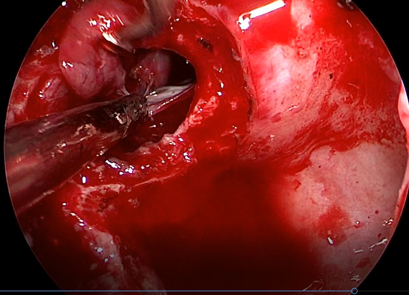垂体瘤手术发生脑脊液漏多层修补技术为患者术后早日康复保驾护航