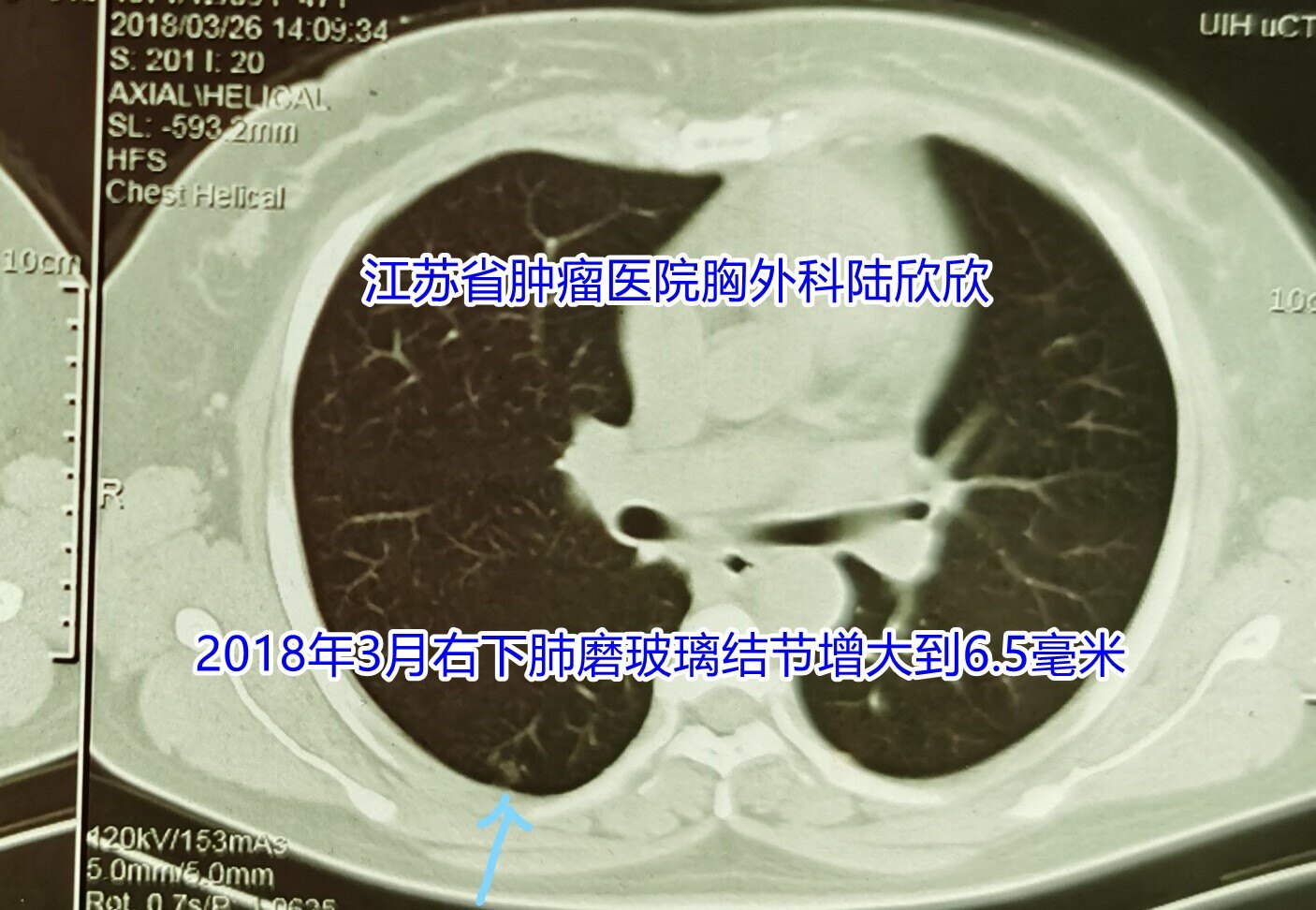 磨玻璃結節故事8一個磨玻璃結節3年半後體積增大17倍