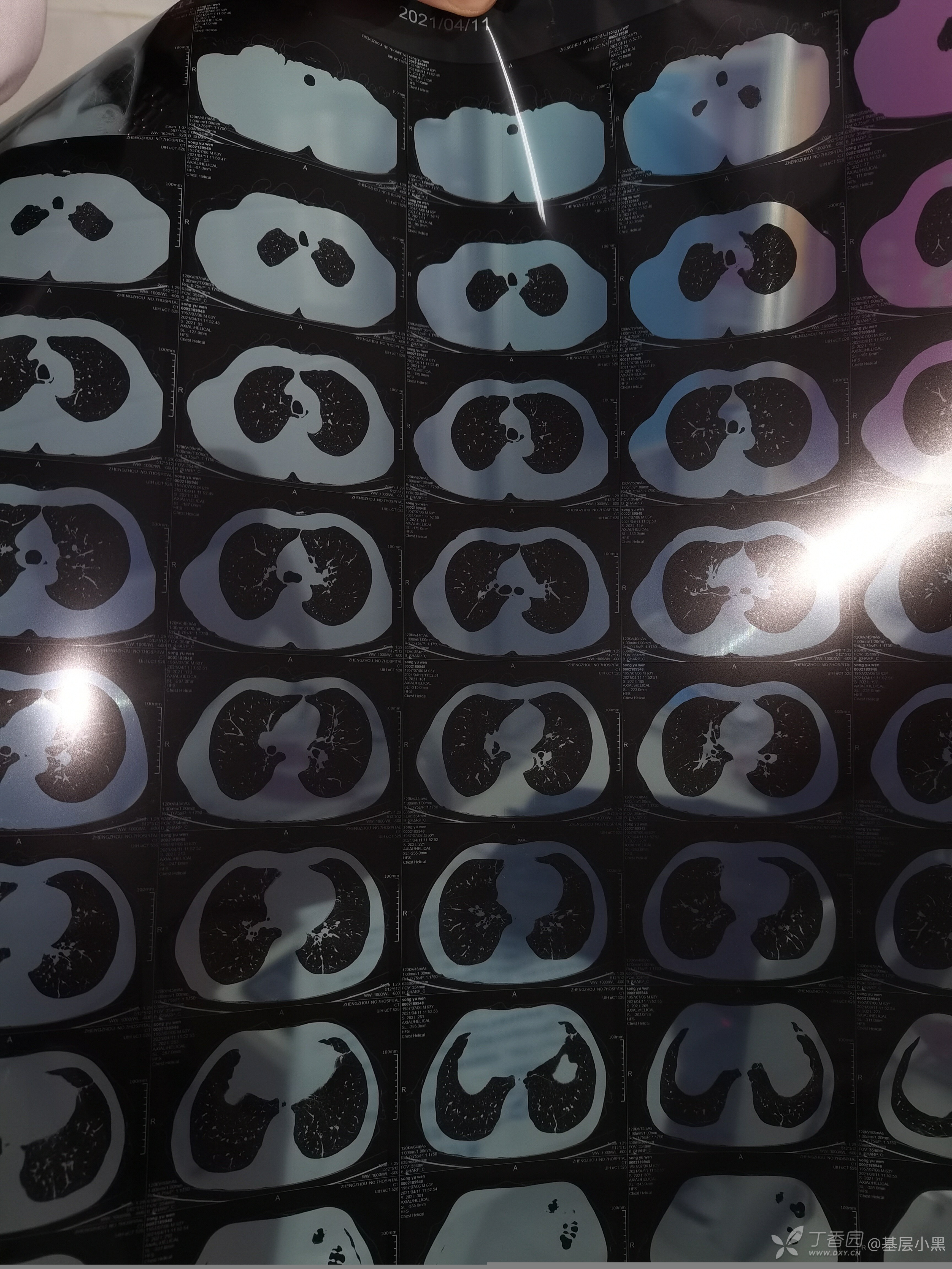 ct片子的照片过来,主要是要看你的肺窗的片子,也就是肺部是灰色的那