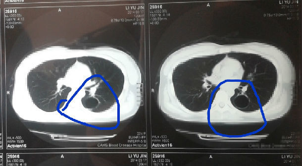 支气管肺囊肿图片