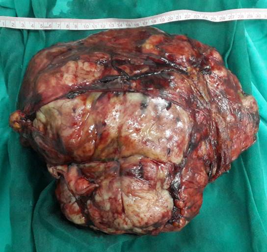 腹腔超巨大型复杂肿瘤完整切除两例(附图) - 好大夫在线