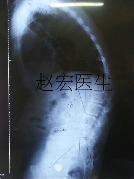 得了强直性脊柱炎出现驼背怎么办? - 好大夫在线