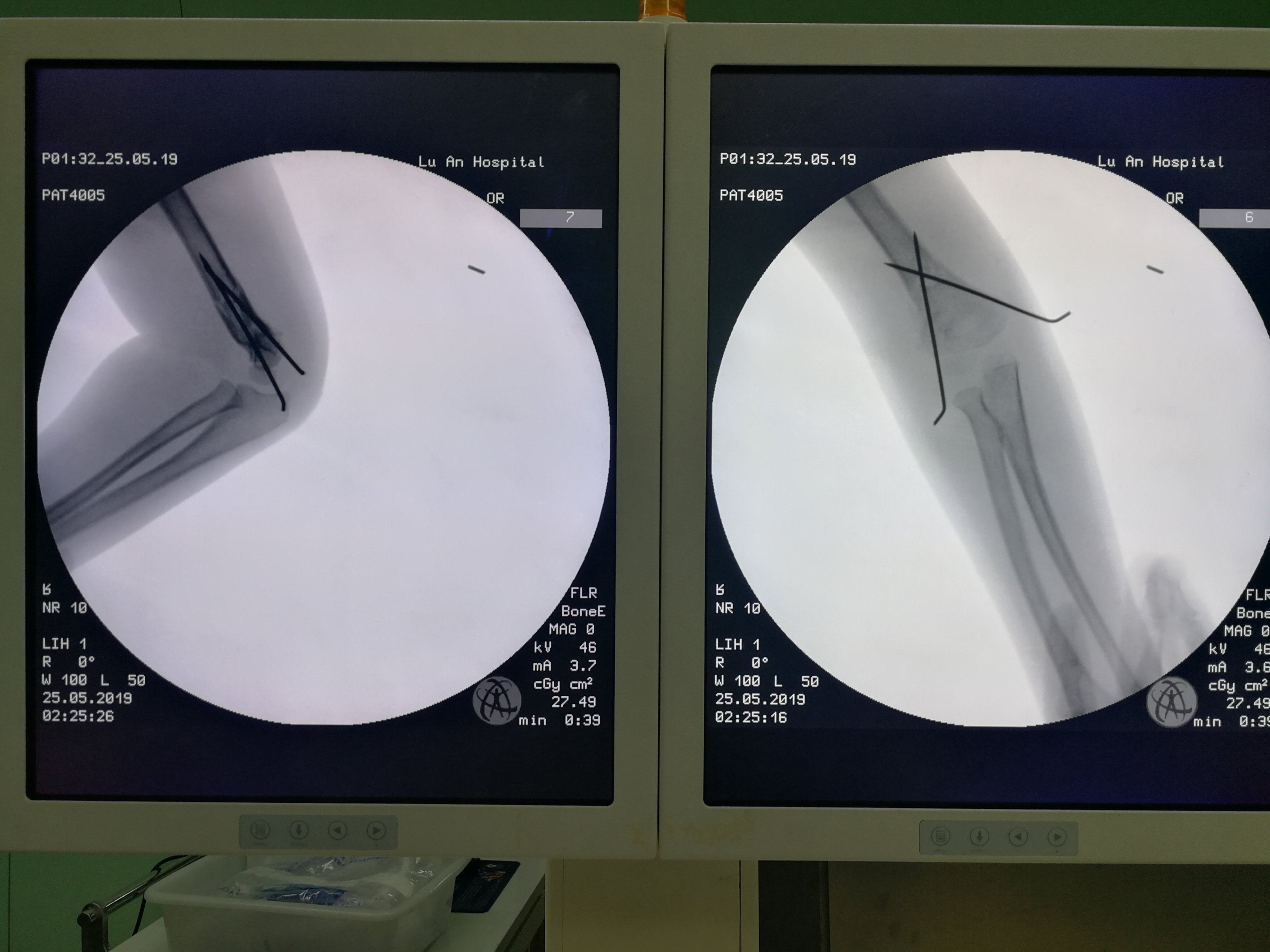 閉合復位小兒橈骨骨折和肱骨髁上骨折