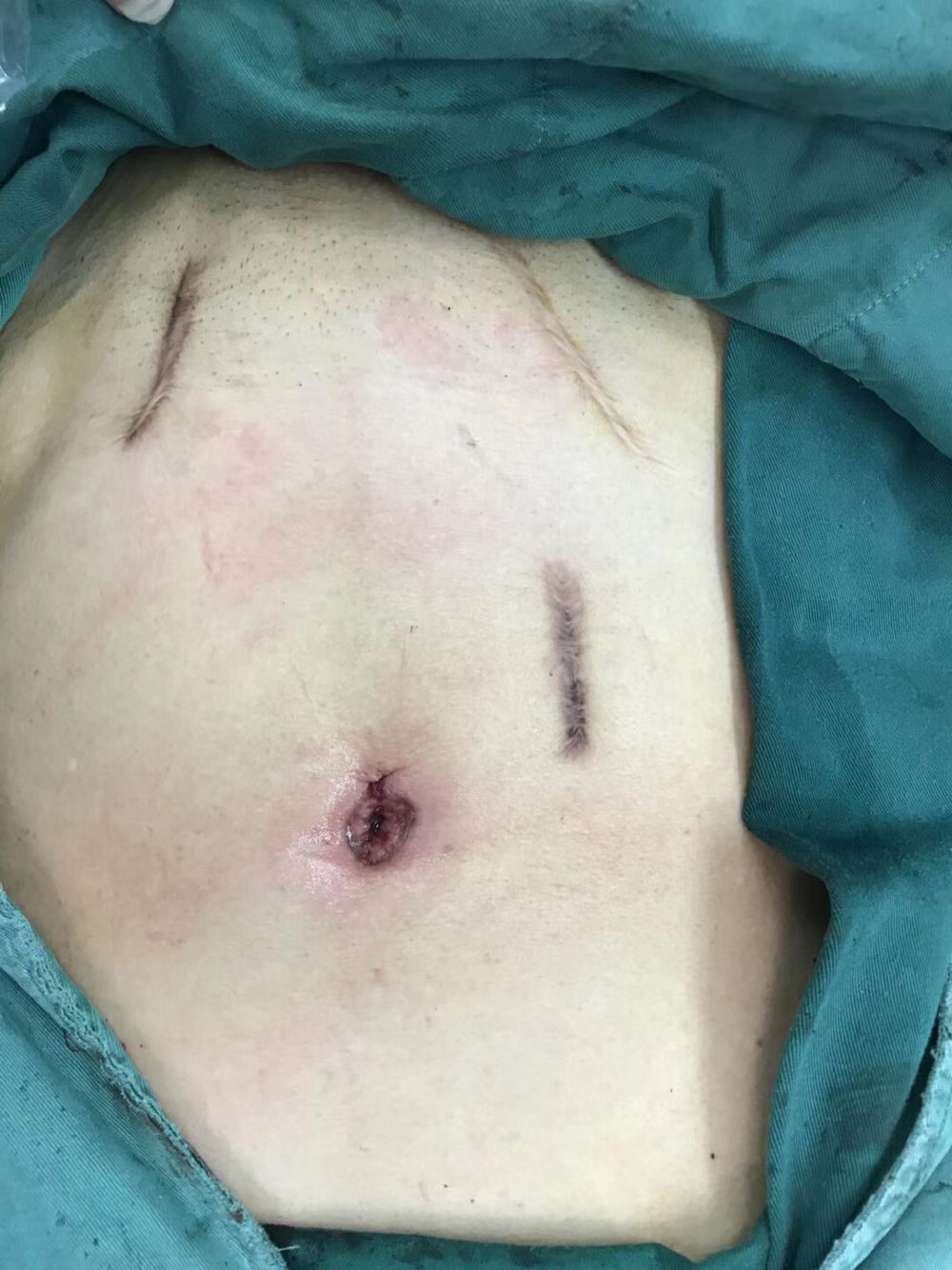 男性疝气手术疤痕图片图片