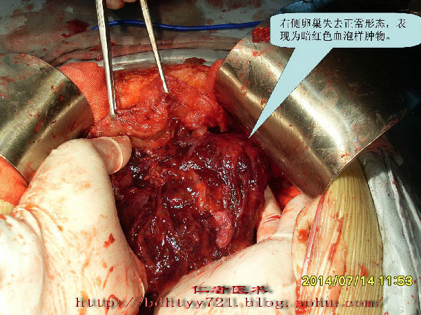 腹膜假黏液瘤病例(1)--带瘤生存,拥有正常人生旅程! - 好大夫在线