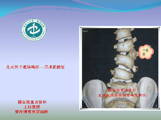 病例:男,8岁,先天性半椎体畸形----艺术的修复 - 好大夫在线