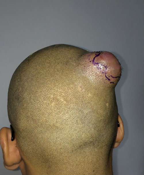 头皮肿物切除术步骤图片