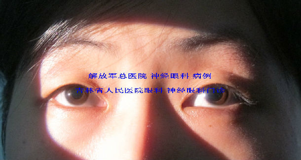 左眼瞳孔药物试验,深反射未见异常