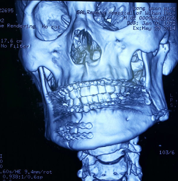 下颌骨多发骨折