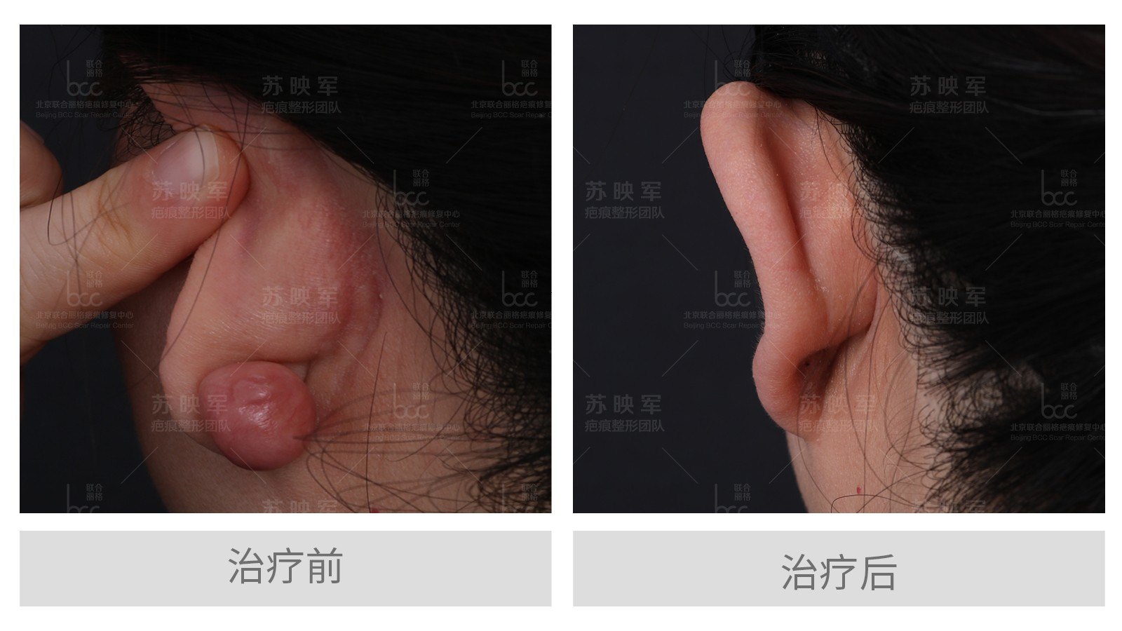 有疤痕疙瘩病史的患者,打耳洞时需谨慎,一定要注意下面几项 - 好大夫