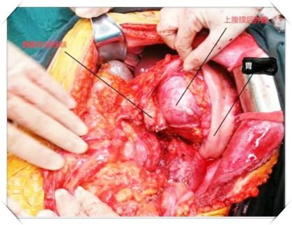 我科成功切除一例腹膜后巨大肉瘤