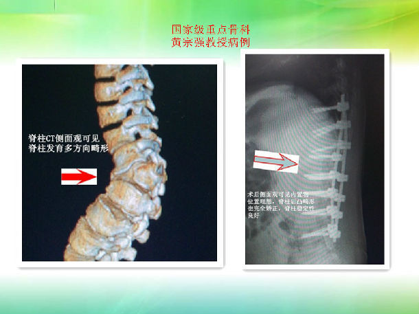 先天性脊柱侧弯成功手术,患儿的腰不弯了