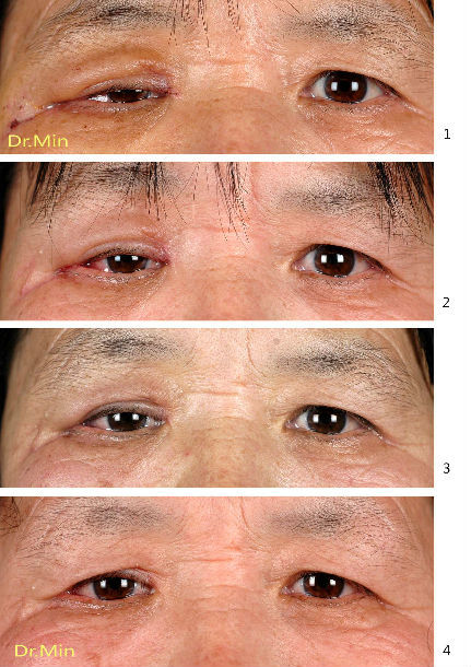 眼瞼腫瘤切除後的整復病例1