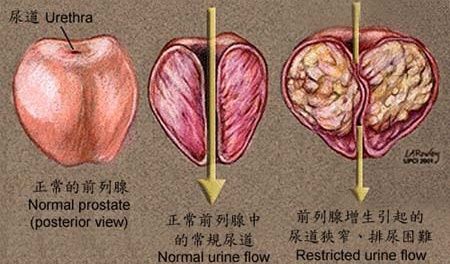 良性前列腺增生手术小贴士 - 好大夫在线