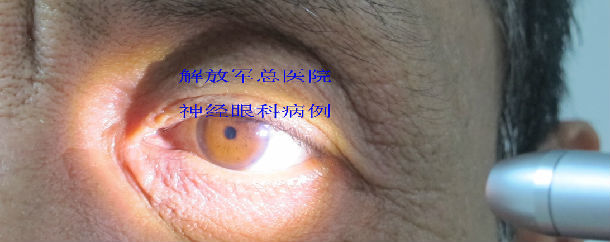 argyll roberston瞳孔,神经梅毒一例