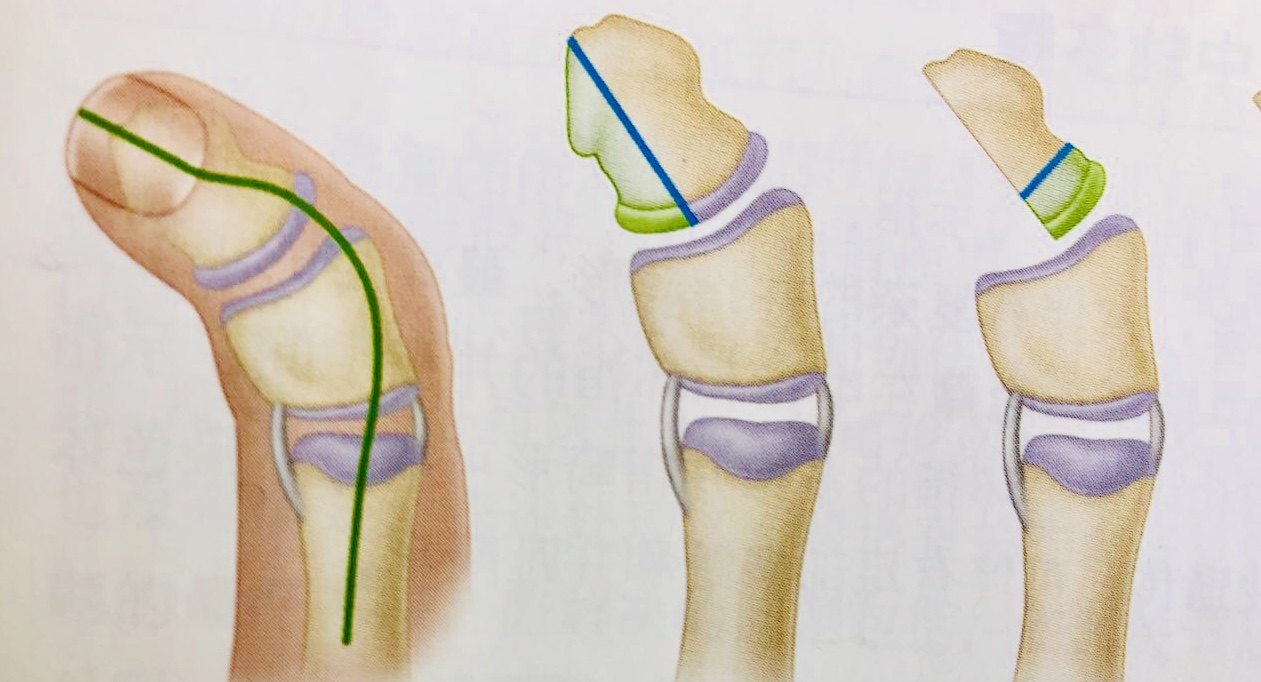技術79-25畫出指骨和骨骺畸形簡圖,計劃截骨部位和截骨長度;畫出指背