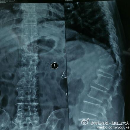 驼背畸形的截骨矫形手术病例(2014.10)