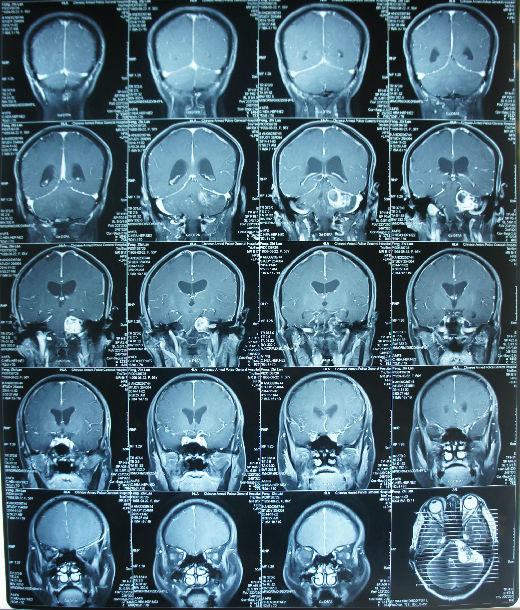 一例听神经瘤患者术前术后mr对比 - 好大夫在线