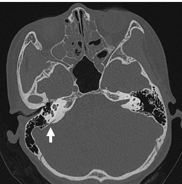大前庭导水管综合征的ct影像学诊断 - 好大夫在线