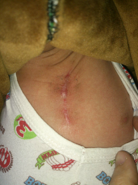 宝宝心脏手术疤痕图片图片