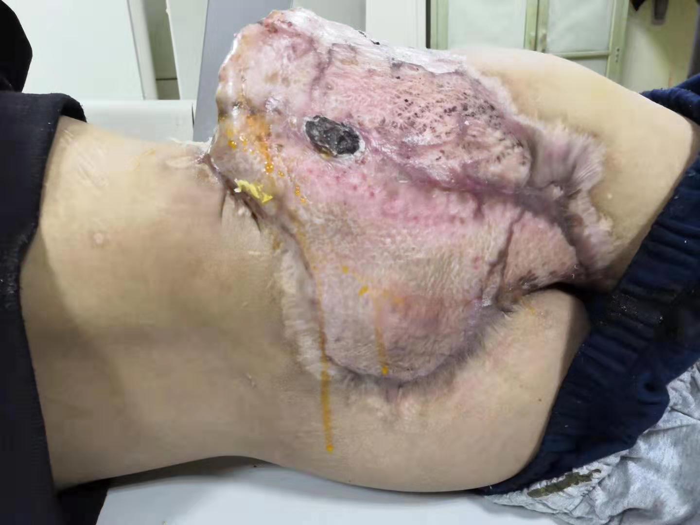 腹壁巨大缺损的肠瘘手术,腹腔开放技术的别样应用 - 好大夫在线