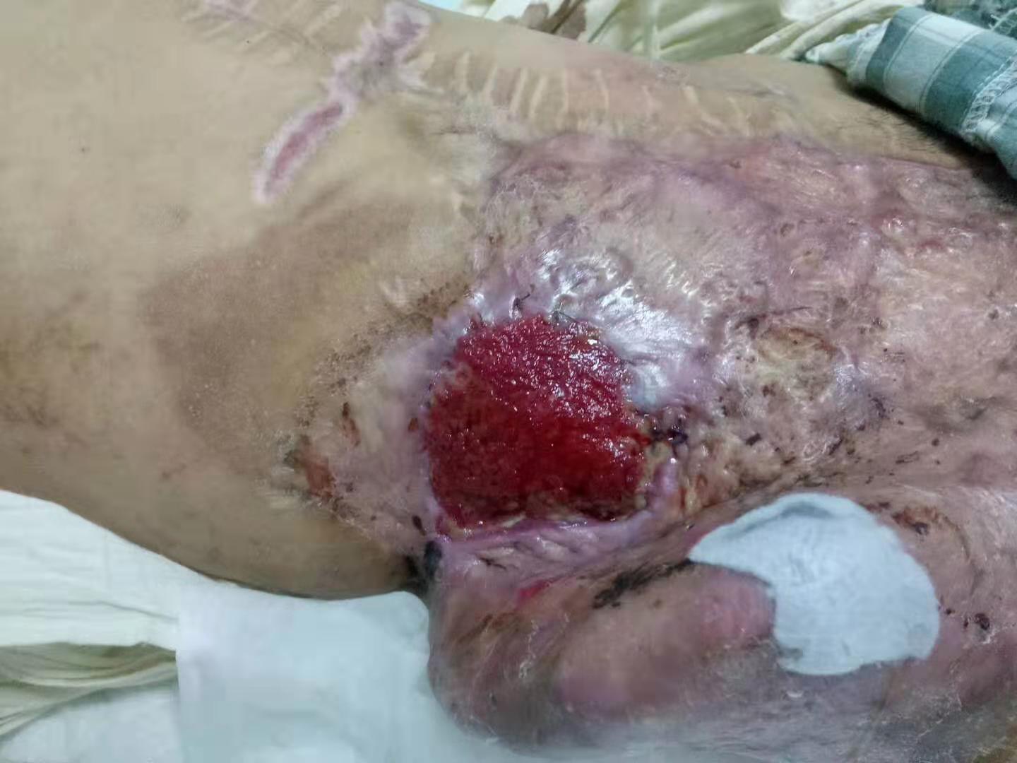 腹壁巨大缺损的肠瘘手术,腹腔开放技术的别样应用 - 好大夫在线