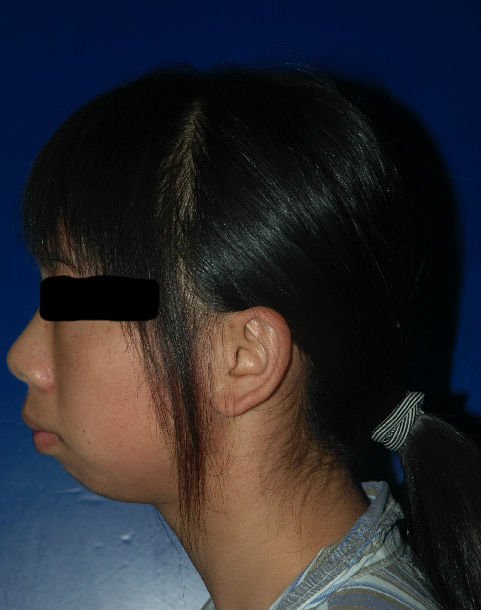 小颌畸形综合征的图片图片