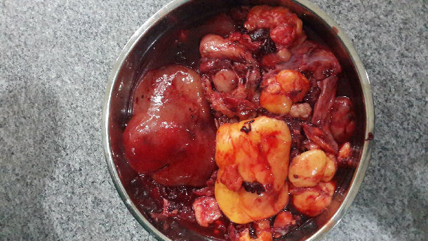 5年前腹部巨大脂肪肉瘤,再次复发,手术切除8kg