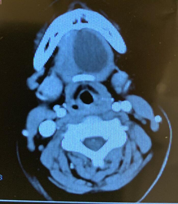 甲狀舌管囊腫