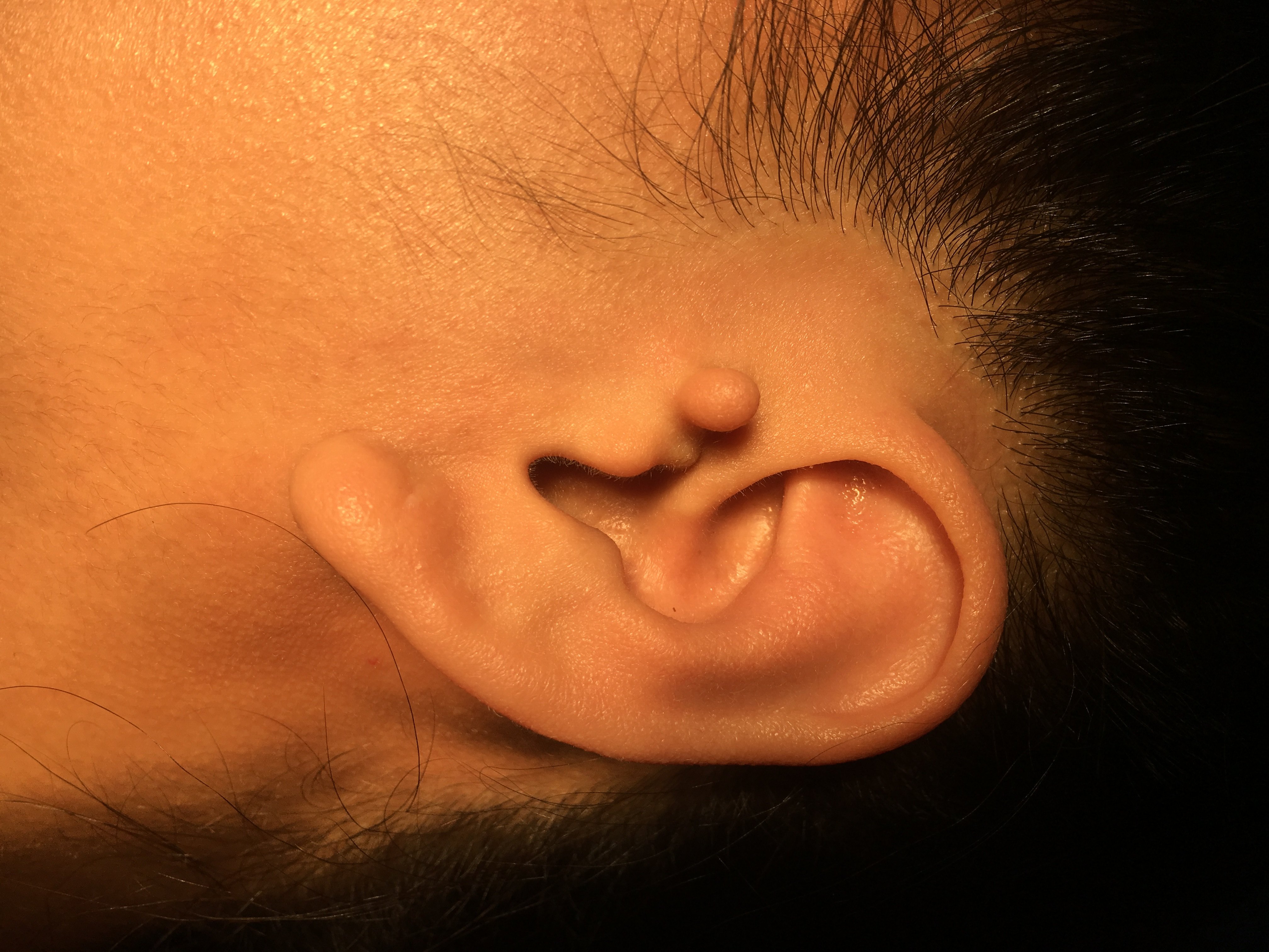 角膜皮样瘤 附耳图片