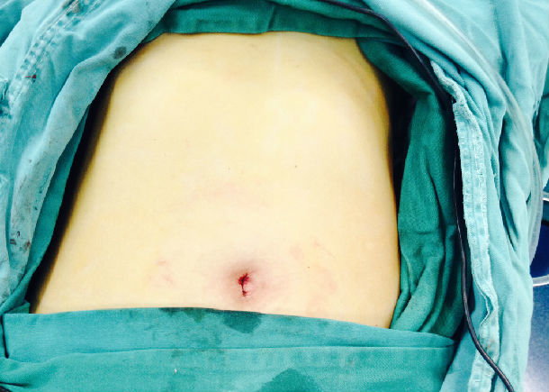无疤痕腹腔镜手术——单孔腹腔镜胆囊切除