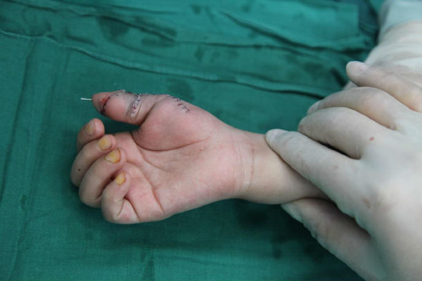 复杂的拇指多指畸形典型病例