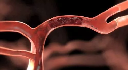 说好不破,夹层还是破了(一)——颅内动脉夹层的病因与检查_脑动脉瘤