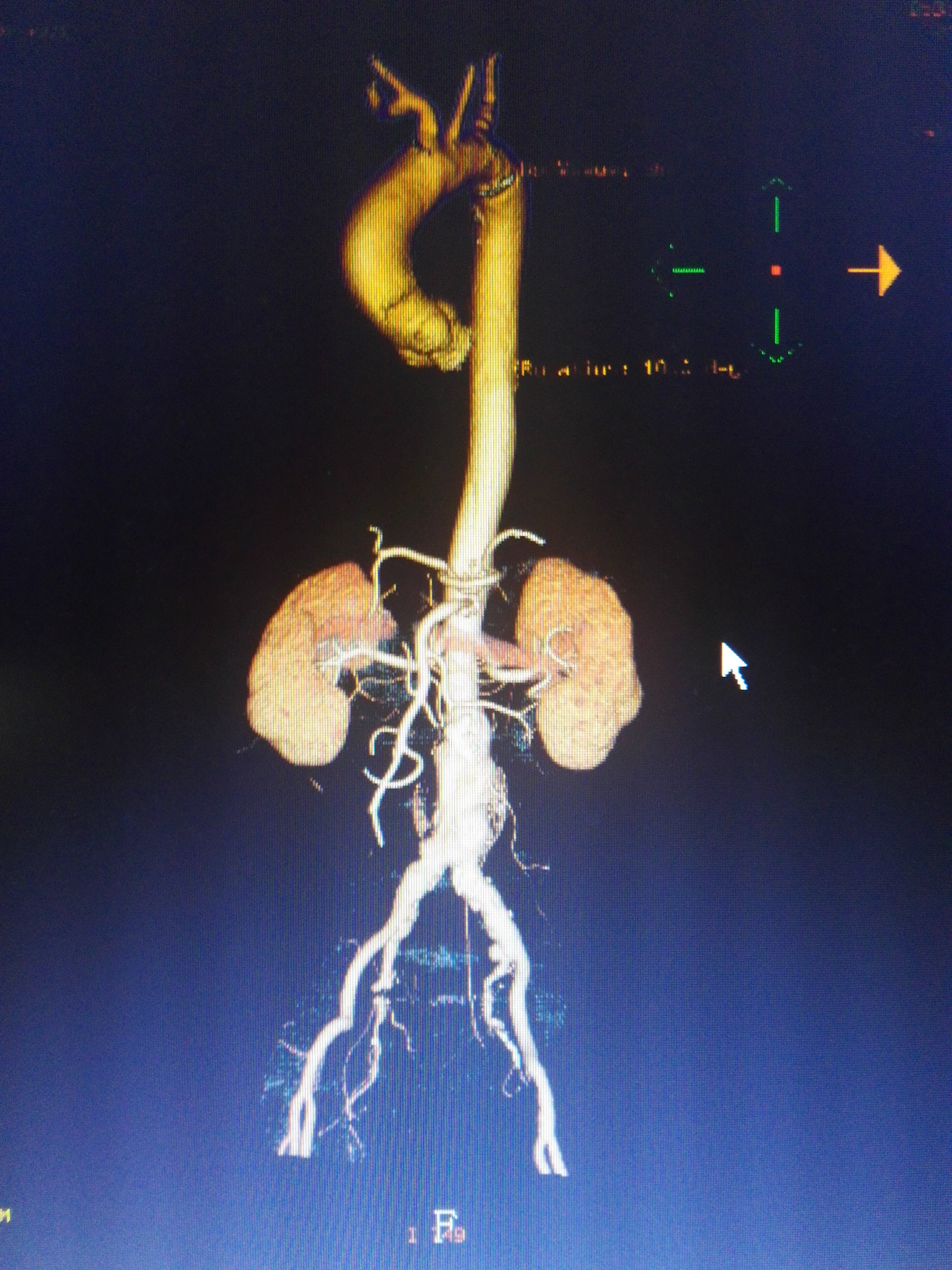 近期腹主动脉瘤腔内隔绝术一例