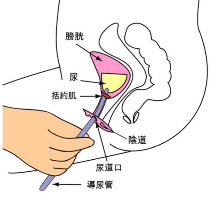 女性患者一次性导尿术图片