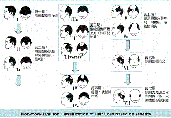 脱发分级.gif